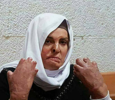 الأسيرة اسراء جعابيص تعاني أوضاع صحية صعبة جداً