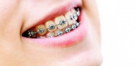 فتوى شرعية حول تقويم الأسنان