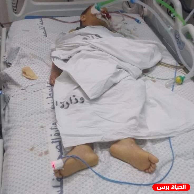 اول حالة في غزة .. وفاة الطفل خليل ابو معمر نتيجة اصابته بالتهاب كبدي