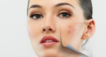 ماسك خل التفاح لعلاج حب الشباب