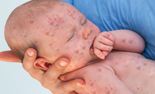 صحة غزة تكشف عدد حالات الإصابة بمرض الحصبة - اعراض الحصبة